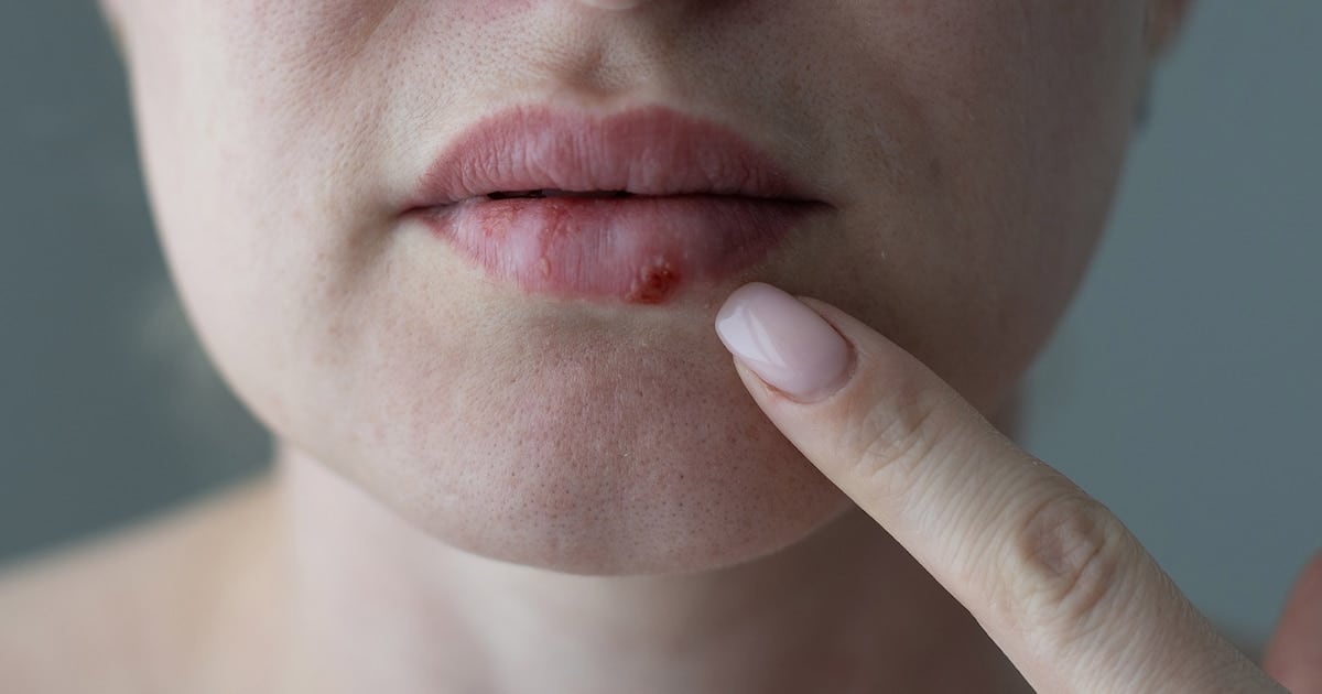 Una pastilla nueva para el herpes que no responde: la FDA abre la puerta a pacientes que llevaban años sin salida