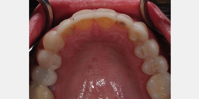 Carillas dentales: las filtraciones que nadie ve y que pueden arruinarte el diente desde adentro